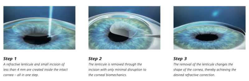 Laser Eye Surgery Procedures - Smile